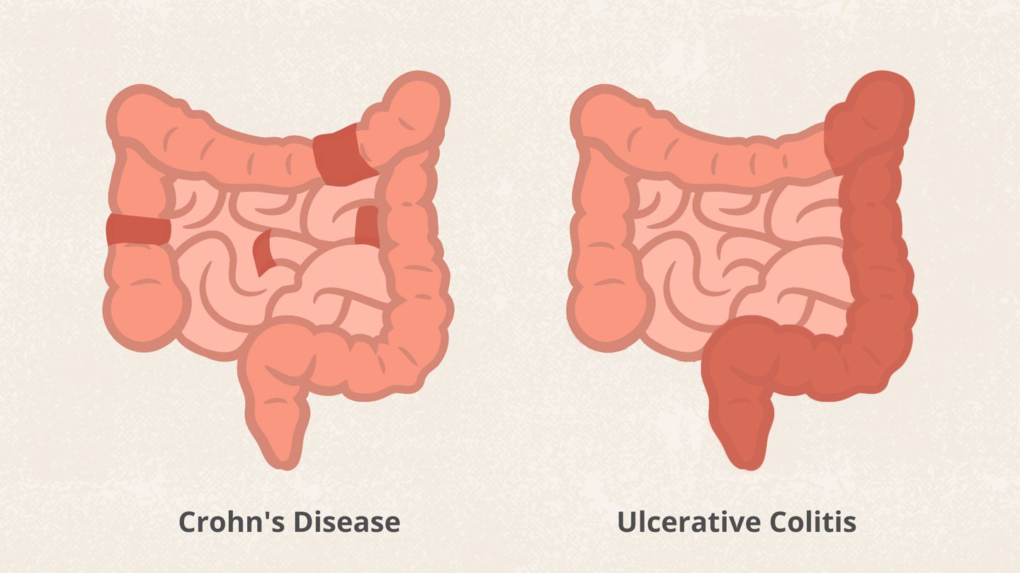 Understanding Crohn's Disease: Symptoms, Causes, and Treatment Options