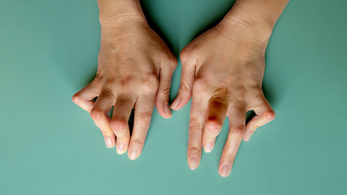 Rheumatoid Arthritis